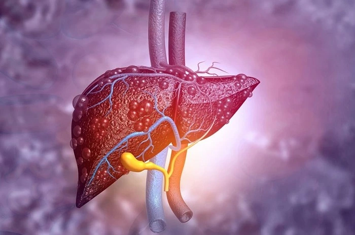 Um teste não invasivo foi desenvolvido para detectar fibrose hepática