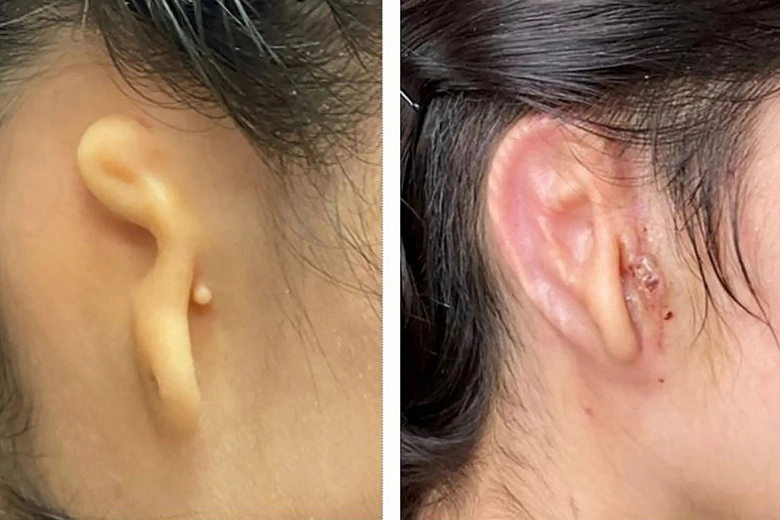 Negli Stati Uniti, il lavandino dell'orecchio è stato stampato su una stampante 3D, che i medici hanno trapiantato con successo alla donna